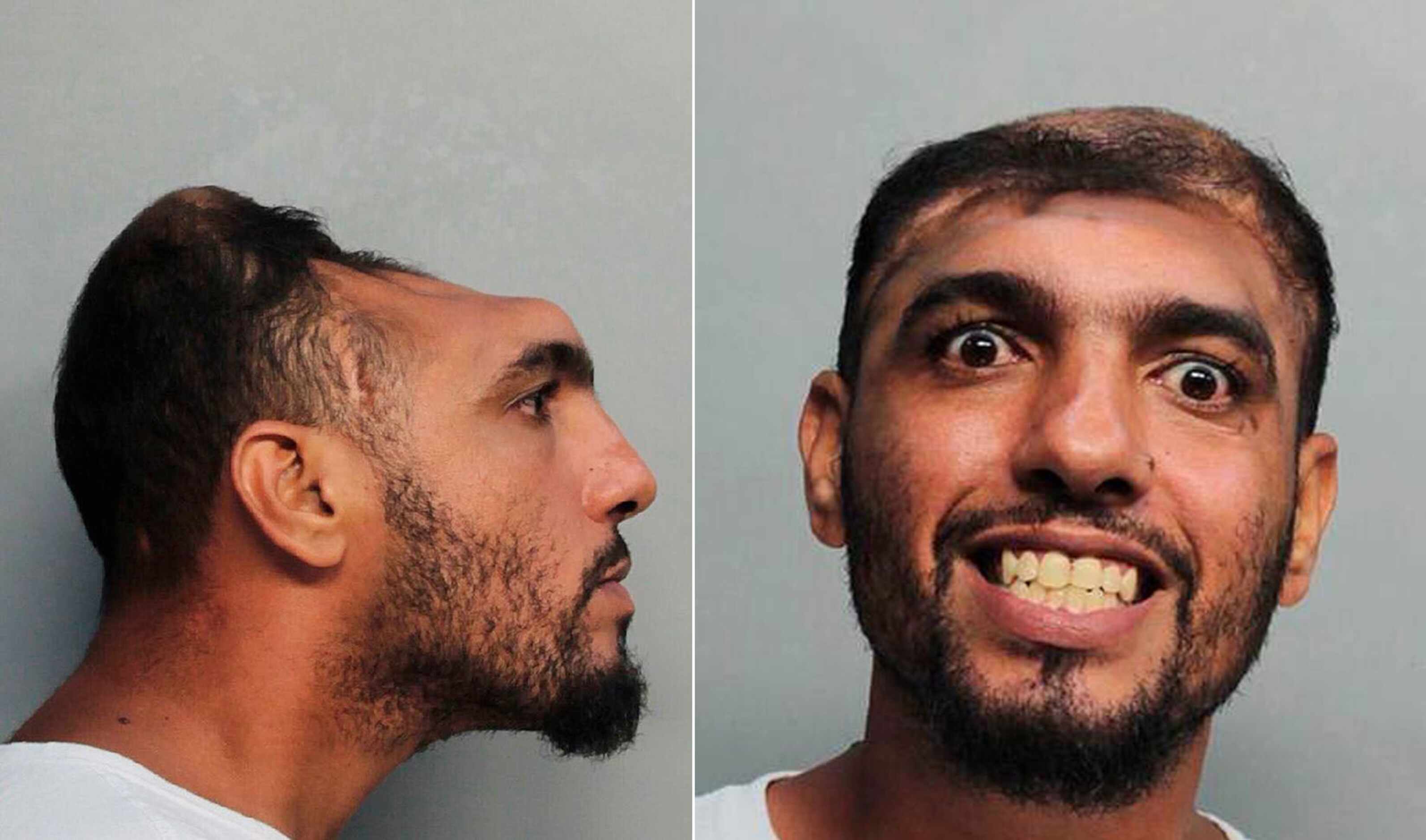 Photo of Miami man with half of a skull goes viral