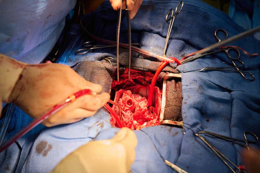 NYU Langone Health surgeons prepared to reattach the deceased recipient's blood vessels to a...