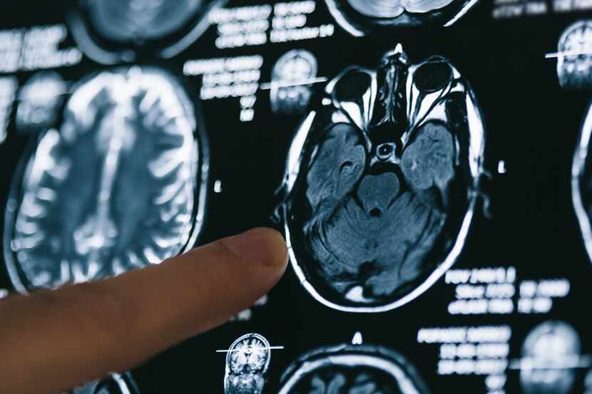 Una resonancia magnética en el cerebro de una persona.