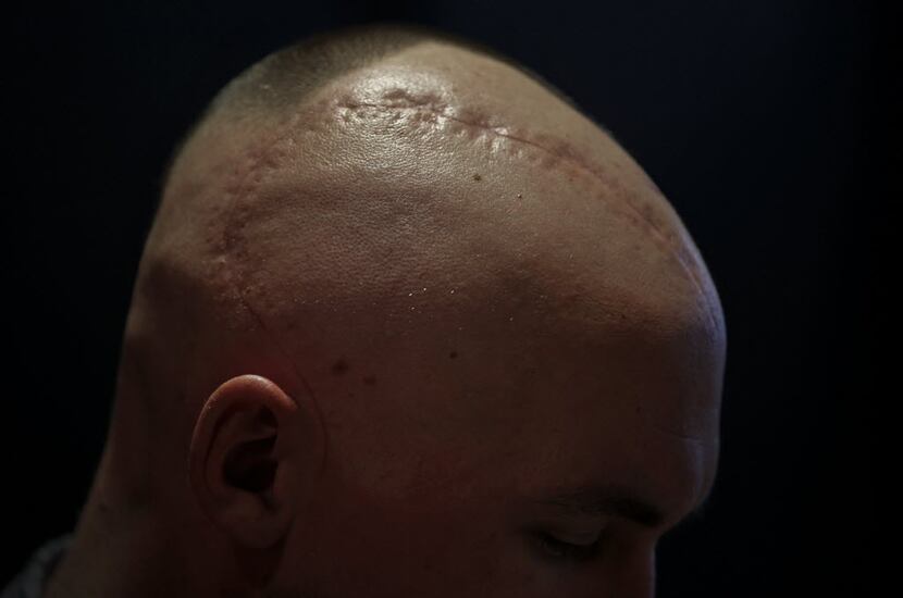 A scar from a brain surgery is seen on Chase Sims' head at Prestonwood Baptist Church in...