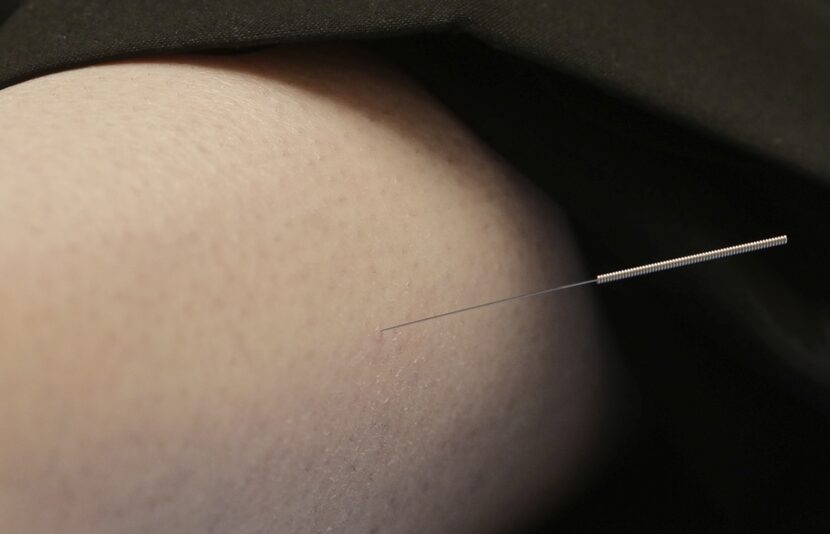 An acupuncture needle in her leg helps Bonnie Sue Garcia combat migraines.