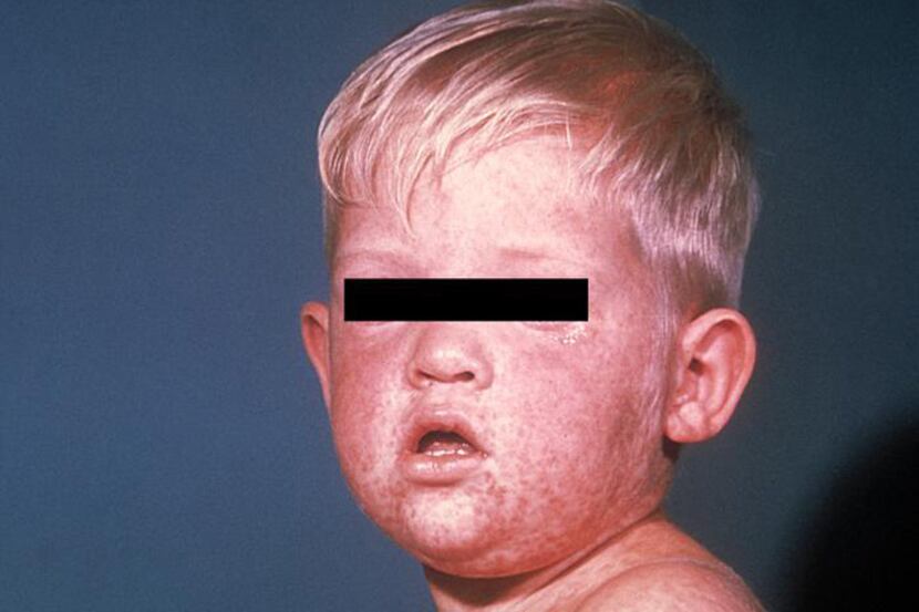  A Centers for Disease Control and Prevention photo of a child with measles.
