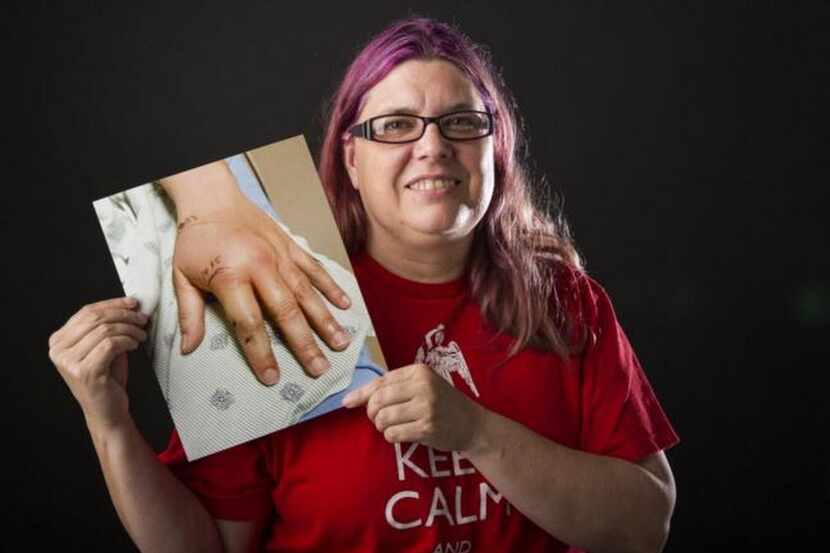 Lori Ulmer, de 46 años, muestra una imagen de su mano luego de ser mordida por una serpiente...