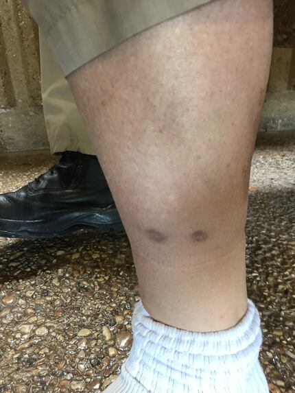 Garland ISD Officer Bruce Joiner's lower left leg shows scars of the entry and exit points...