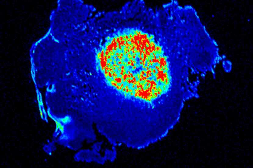 An image of illuminated cells in a cancer tumor from a UT Southwestern study in mice.
