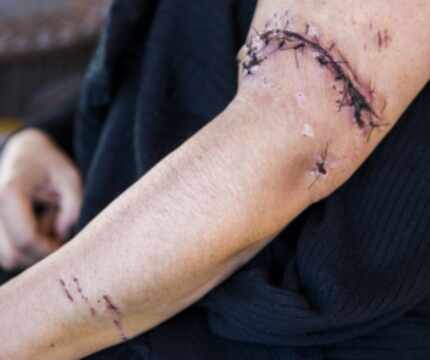  Luz Maria Rios shows stitches on her left arm received after being attacked by two dogs...