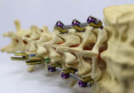 A model of a spine with screws in place in Courtney’s office. 