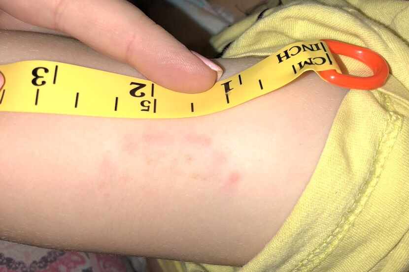 Audra Elliott photographed her daughter's arm the evening after her teacher at Twin Creeks...