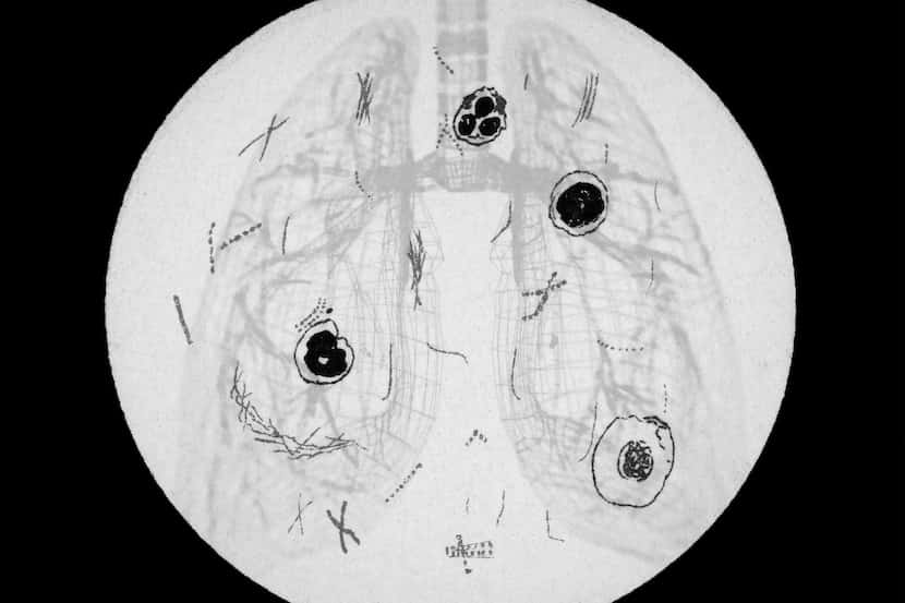 A photo illustration shows a black and white diagram of lungs superimposed over an old...