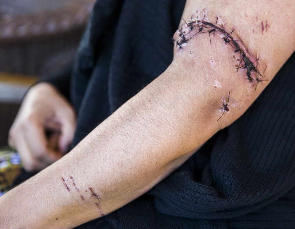 Luz Maria Rios shows stitches on her left arm Friday, May 6, 2016.  While walking her dog,...