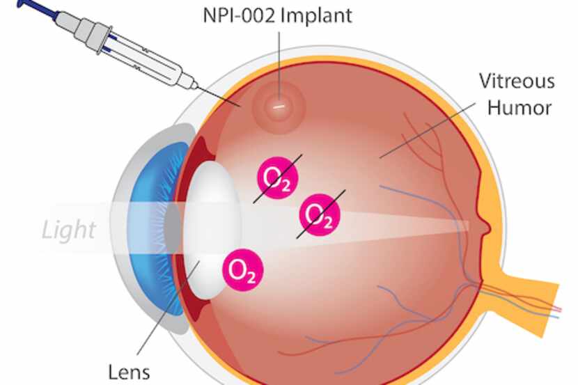 The treatment for cataracts, a pharmaceutical implant, is inserted into the vitreous of the...