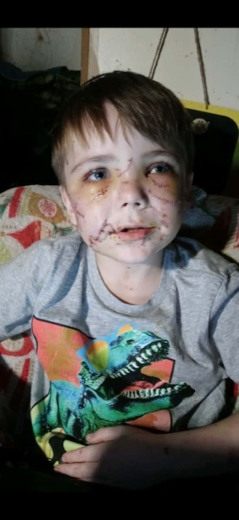Conner Landers, 7, was attacked by a dog on his walk home from the school bus in Parker...