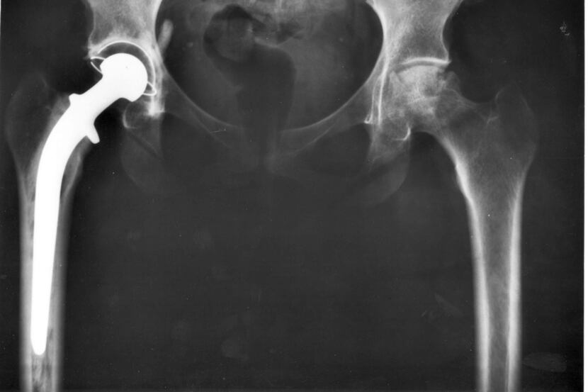 This National Institutes of Health X-ray of a pelvis shows a total hip joint replacement....