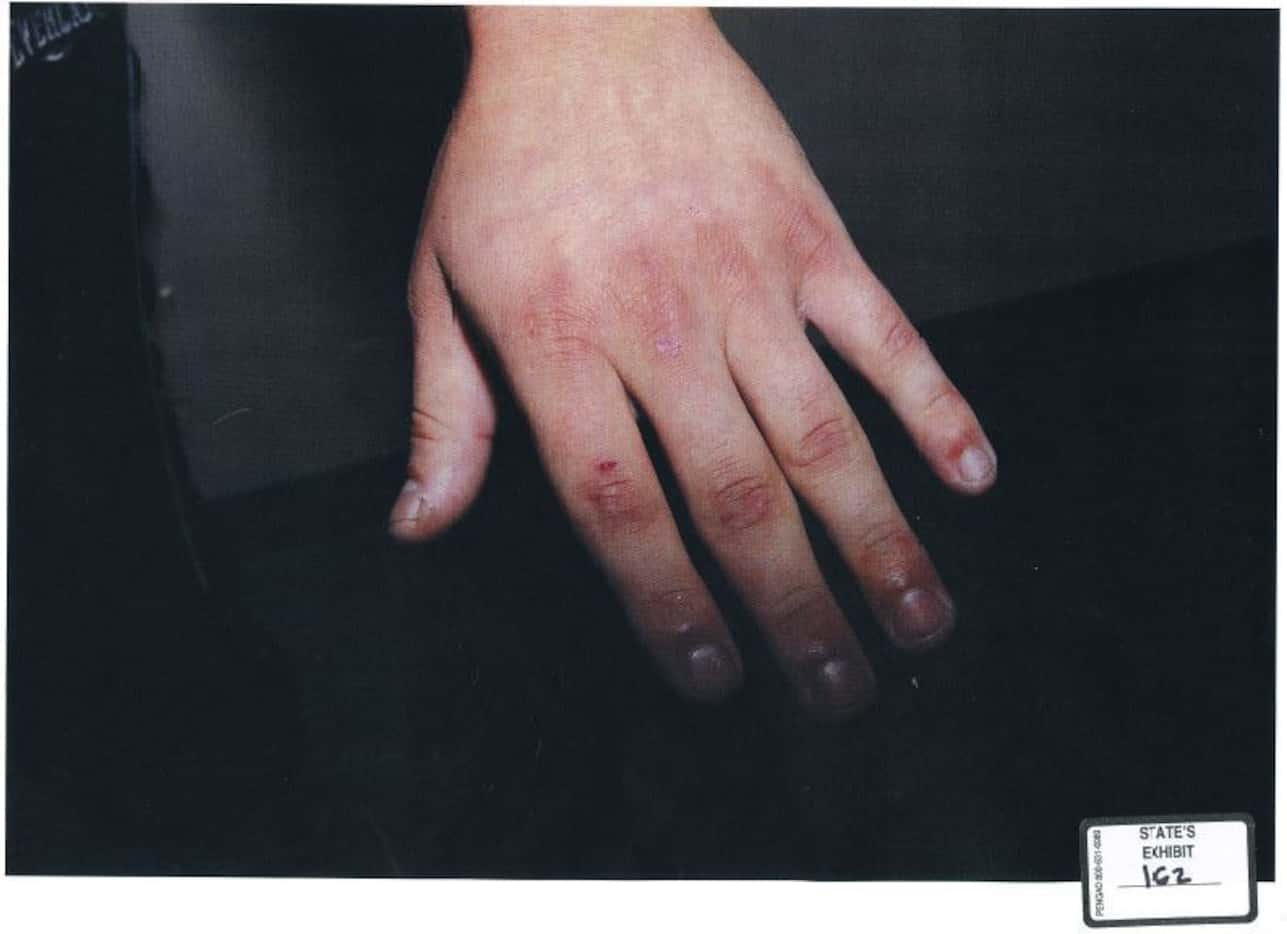 Plano police took photos of the injuries to Enrique Arochi's hands and arms in September 2014.
