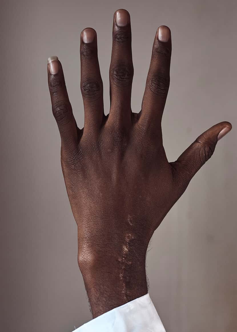 Abdoul, 32 year-old migrant from Maghama, Mauritania poses for a photograph showing surgery...