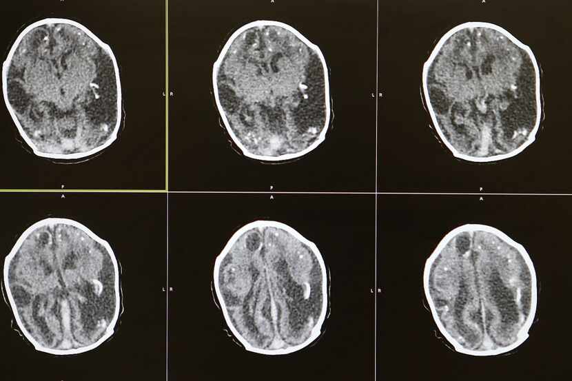  RECIFE, BRAZIL - JANUARY 27: Brain scans of a 2-month-old baby with microcephaly are...