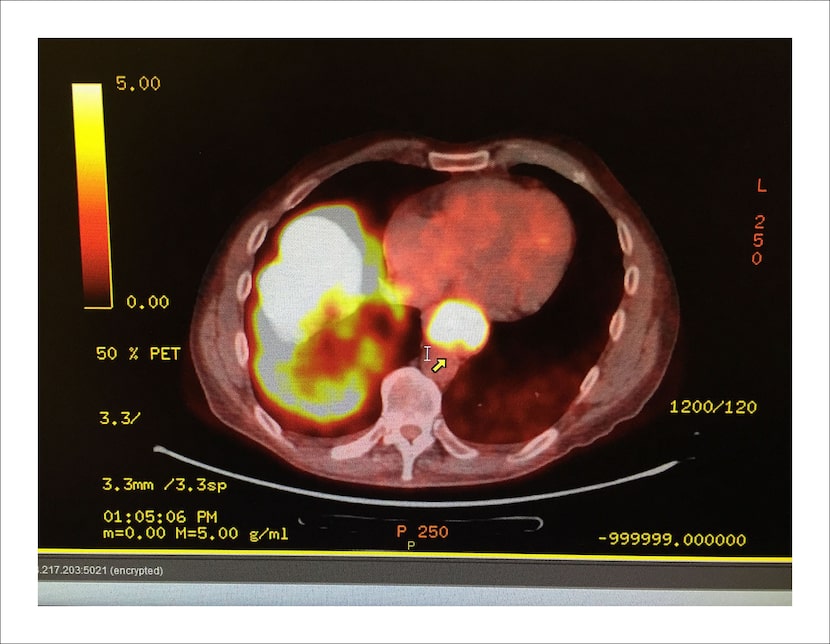 9/19/16 — This one had to be in color. PET scans show the heat profile of cells. Cancer...