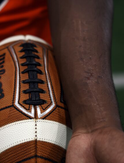 The residual scar on the underside of Ti'Erick Martin's left foreman serve as a reminder of...