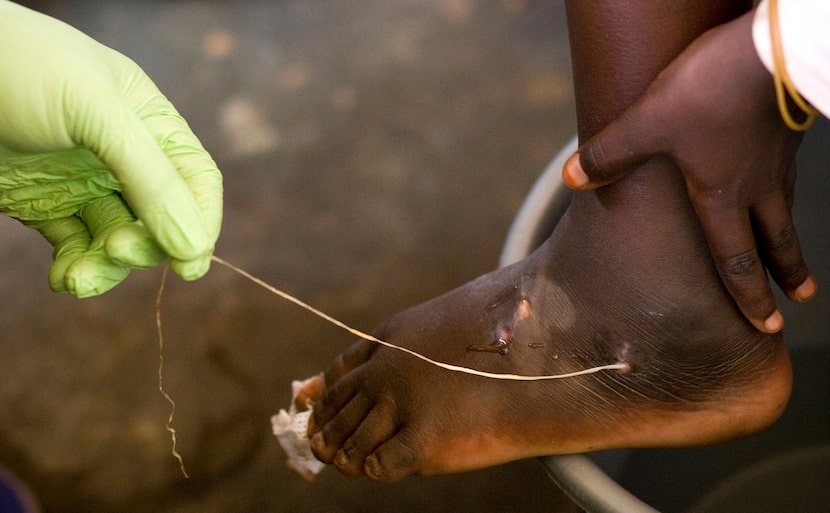 FILE - In this March 9, 2007 file photo, a guinea worm is extracted by a health worker from...