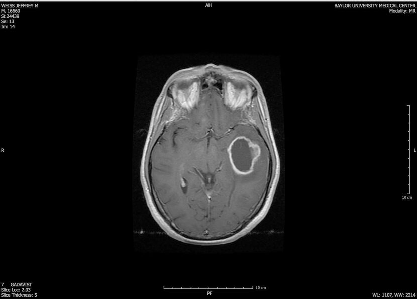 This is a view of the egg-sized tumor known as a glioblastoma inside the writer's skull...