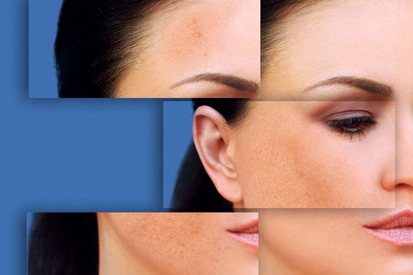 Dark spots, freckles, hyperpigmentation, skin condition (melasma or chloasma)