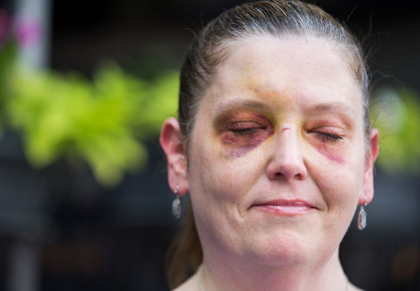 Kelley Mitchum showed her injuries from falling off of a Lime scooter while crossing over...