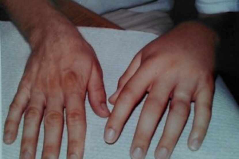  Clint King's hand swelling one hour after being bitten.