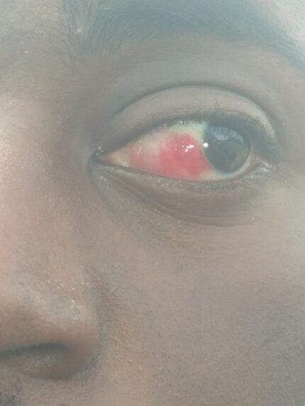 Grant Bible's eye after he was Tased and arrested by DeSoto police officers.