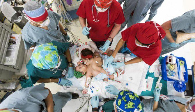 
				Médicos del Childrens Hospital en Houston lograron separar a siamesas tras una...