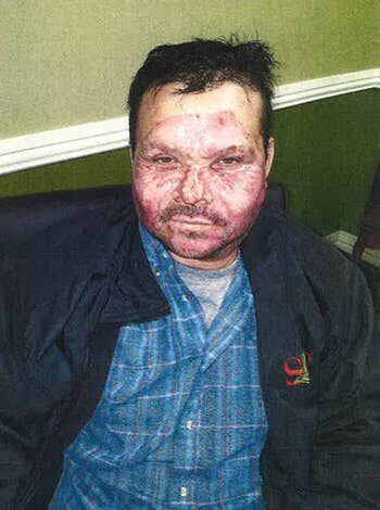 David Lemus, de 49 años, fotografíado poco después de la explosión. Sufrió quemaduras de...