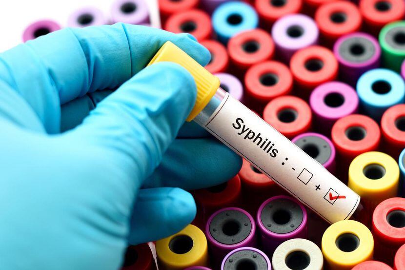 Una muestra de sangre infectada con el virus de sífilis.(getty images)
