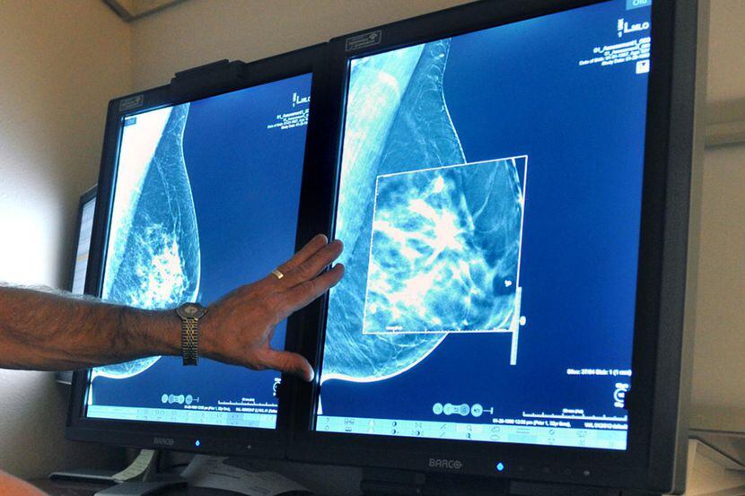 Un radiólogo compara tomas de mamografías. Un estudio reveló que el cáncer en su etapa...